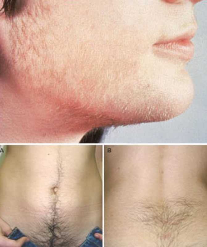 Как избавиться от волос на грудях у мужчин? | блог gold laser