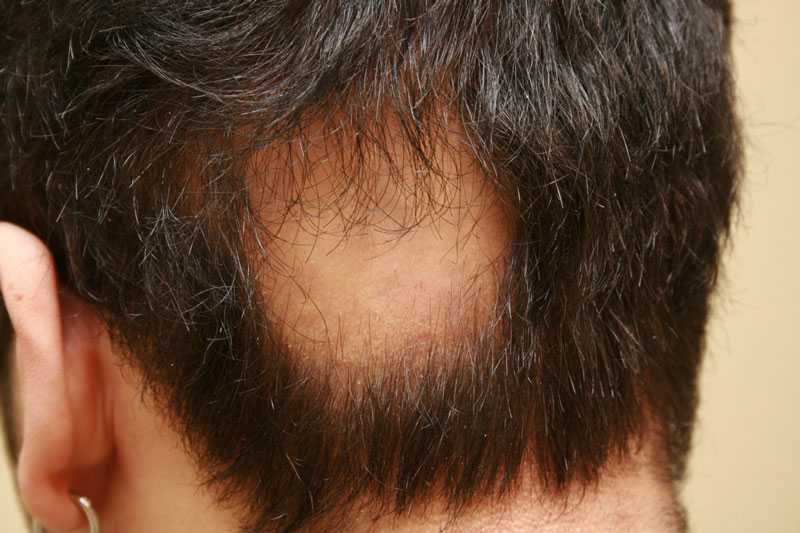 Как избавиться от вросших волос в зоне бикини, что делать и чем вытянуть волосок в домашних условиях - волосовед
