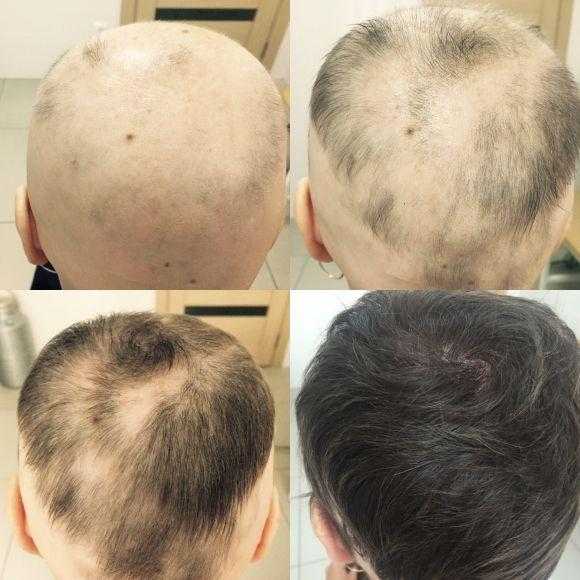 Как избавиться от вросших волос - evolution-clinic.com