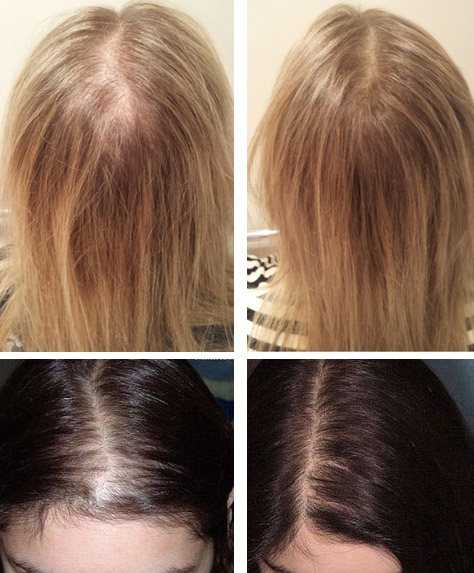 ᐉ инверсия для роста волос – отзывы о методе, фото до и после, как проводится - salonvanila.ru