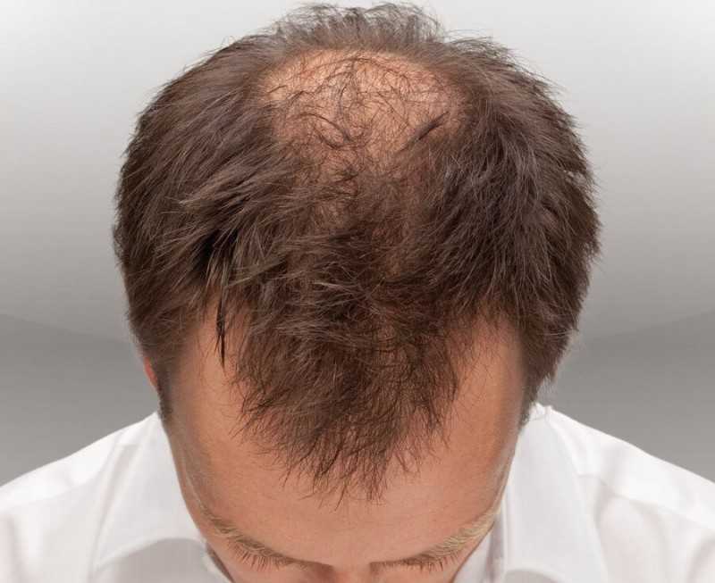Вросшие волосы после эпиляции: как избавиться от неприятного последствия