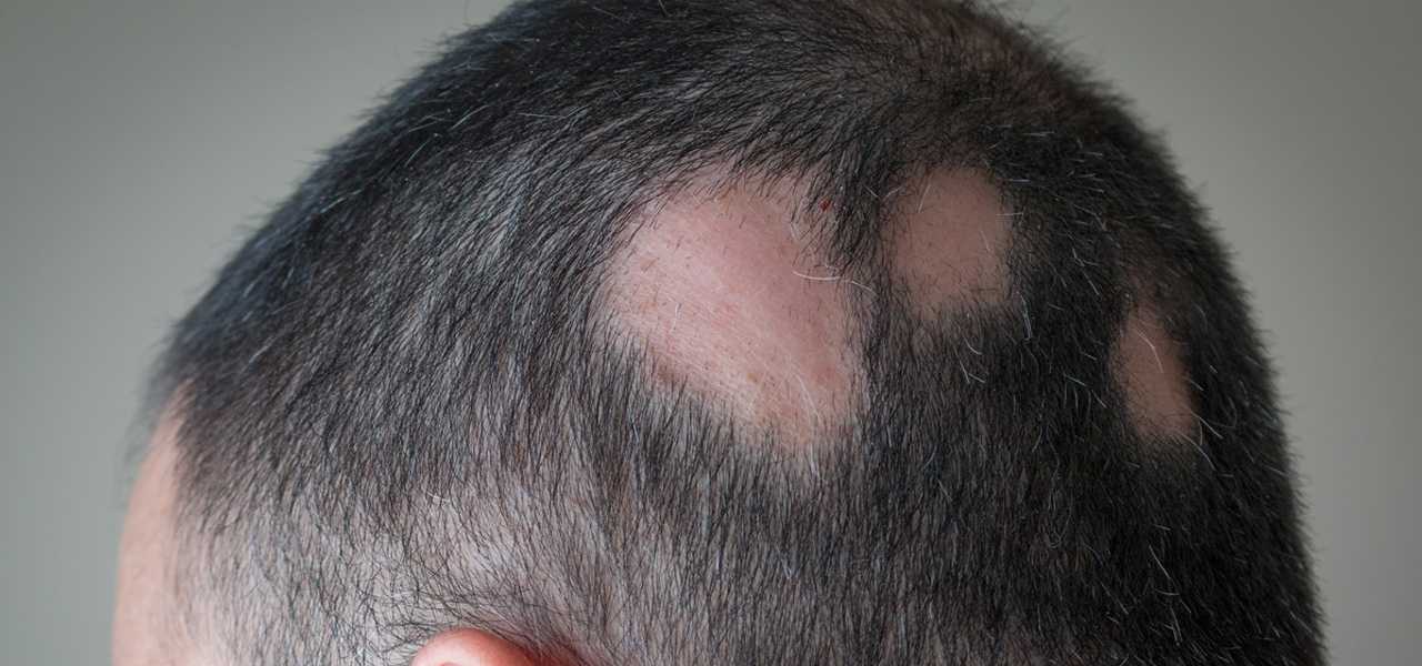 Как решить проблему вросших волос после бритья - dorco.ru