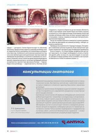 Установка брекетов на зубы — подготовка, этапы, уход на startsmile.ru
