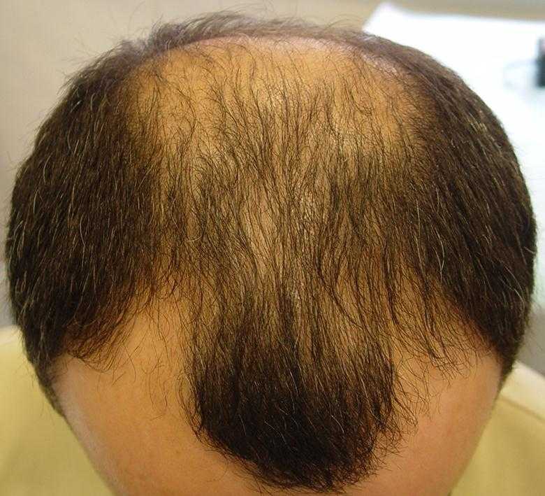 Избыточный рост волос на теле