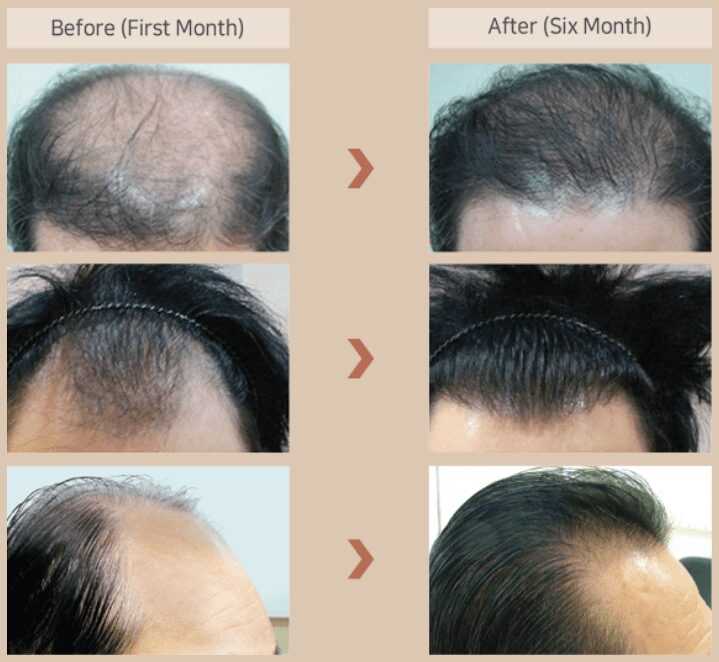Как ускорить рост волос мужчине на голове. Рост волос на голове. Рост новых волос на голове. Ускоренный рост волос на голове. Ускоритель роста волос на голове.