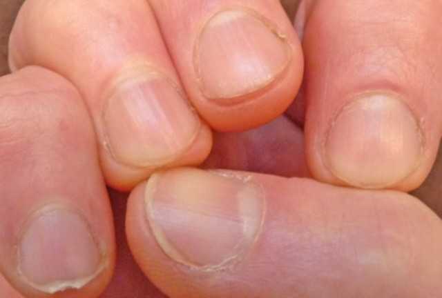 Как перестать грызть ногти на руках - основные способы | психология на psychology-s.ru