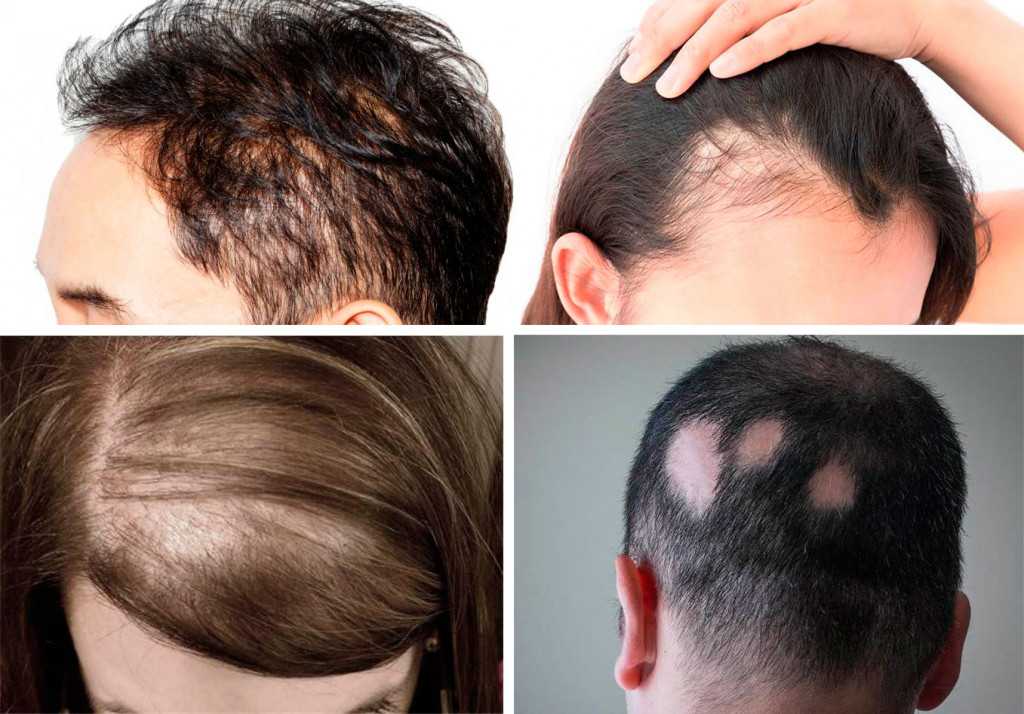 Как избавиться от вросших волос после эпиляции