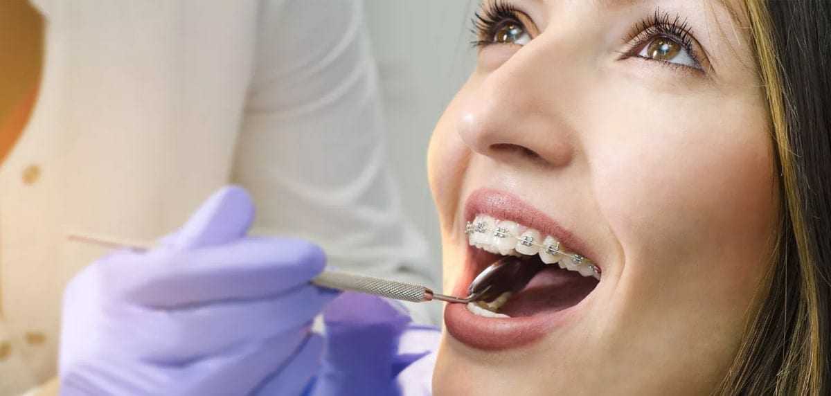 Статья о стоматологии: 14 самых важных вопросов про брекеты
