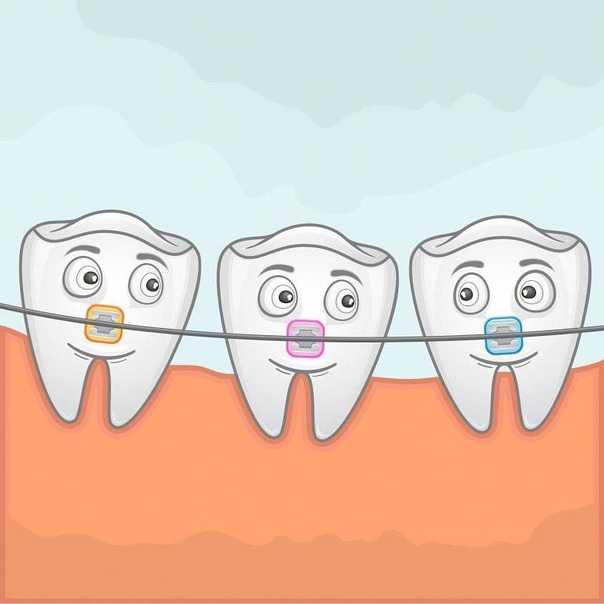 Можно ли поставить брекеты на несколько зубов?