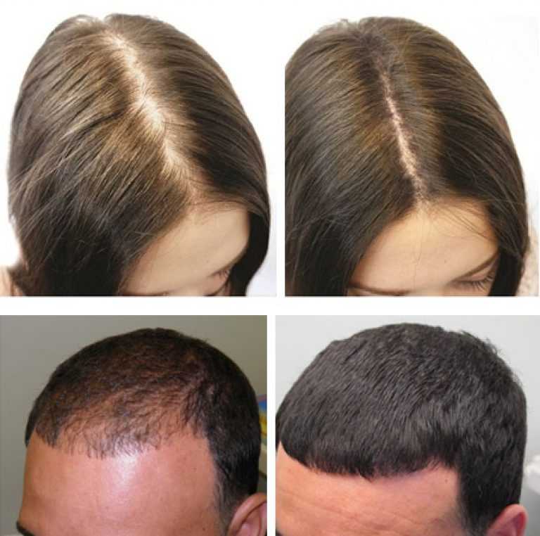 Метод инверсии для роста волос - отзывы с фото до и после, как делать процедуру - lipesinka.ru