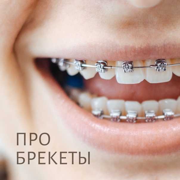 Установка брекетов на зубы