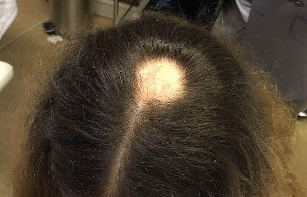 Вросшие волосы: причины, лечение и профилактика, лазерная эпиляция