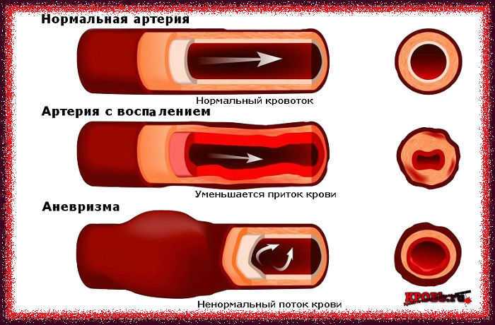 Как определить, чем отличить обильные месячные, или маточное кровотечение - подробная информация кровотечения