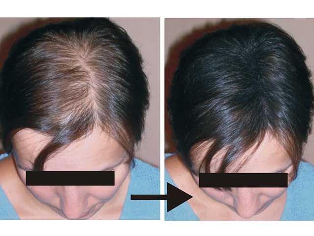 Как бритье головы влияет на рост волос на