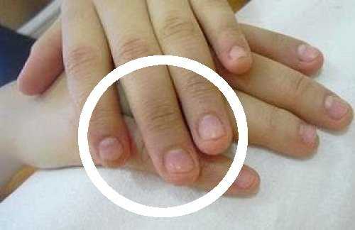 Как перестать грызть ногти